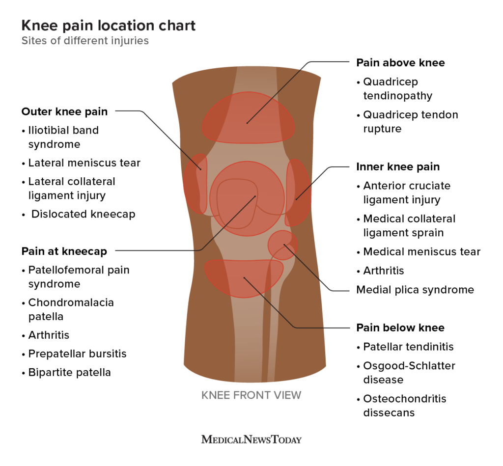 Back Knee Pain Location Chart: Your Guide to Relief